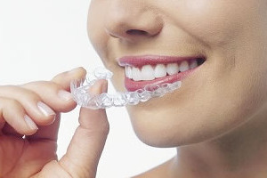 estetica dentara : pozitionarea gutierelor de albire pe dinti 