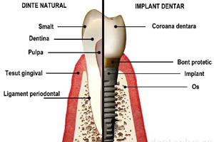 implant dentar comparat cu un dinte natural