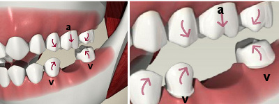 migrarea dintilor dupa extractie este un motiv important al indicarii unei lucrari pe implant dentar